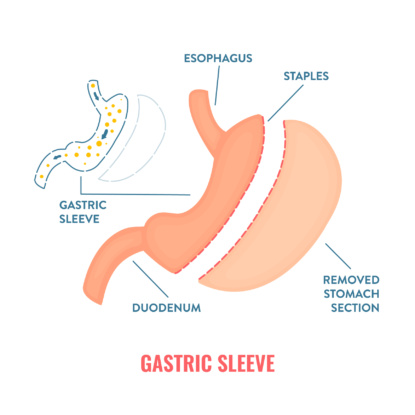 Gastric Sleeve Bariatric Surgery Weight Loss Infographics